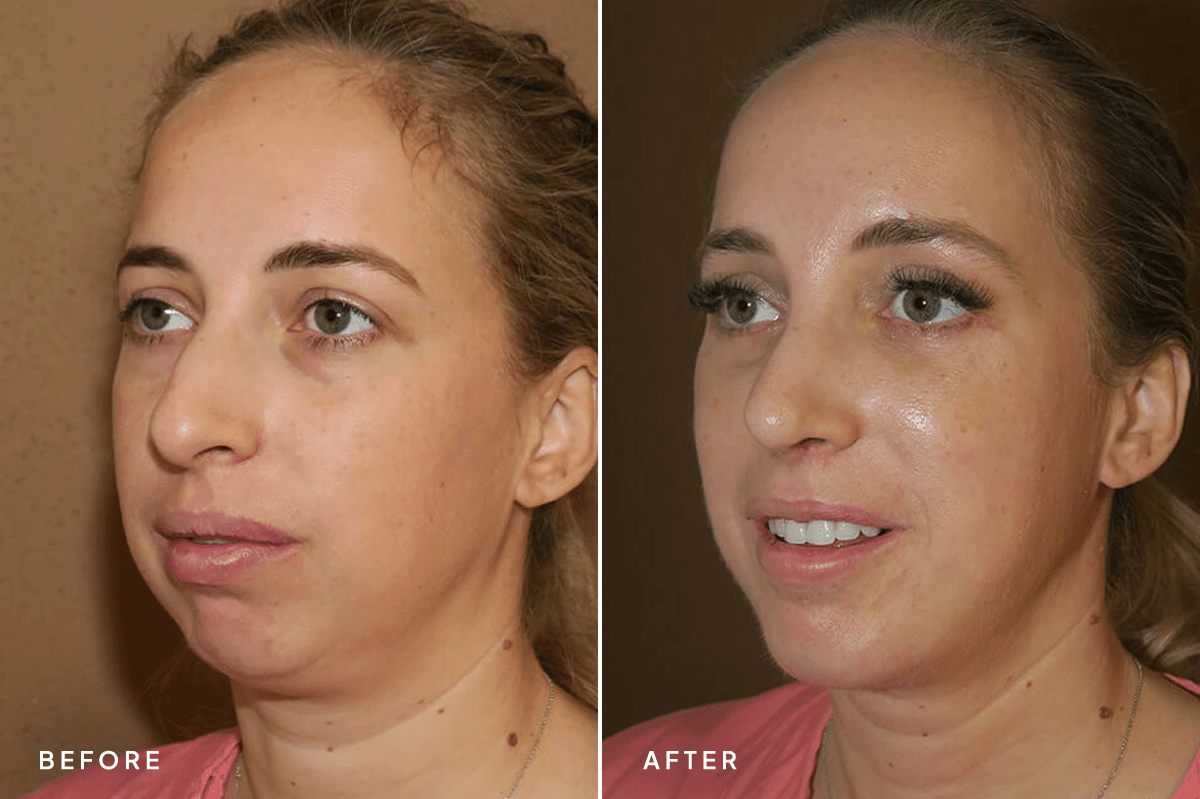 New Horizons Face Gallery | Chin Augmentation | 7135-rhinoplasty | D Angle