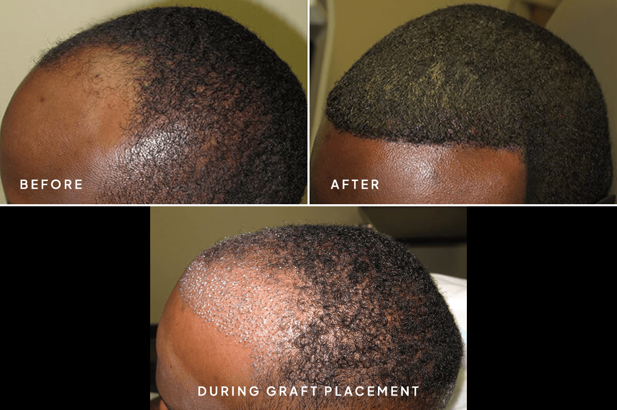 New Horizons Hair Gallery | Hair Transplant | 6652-artas-hair-restoration | B Angle