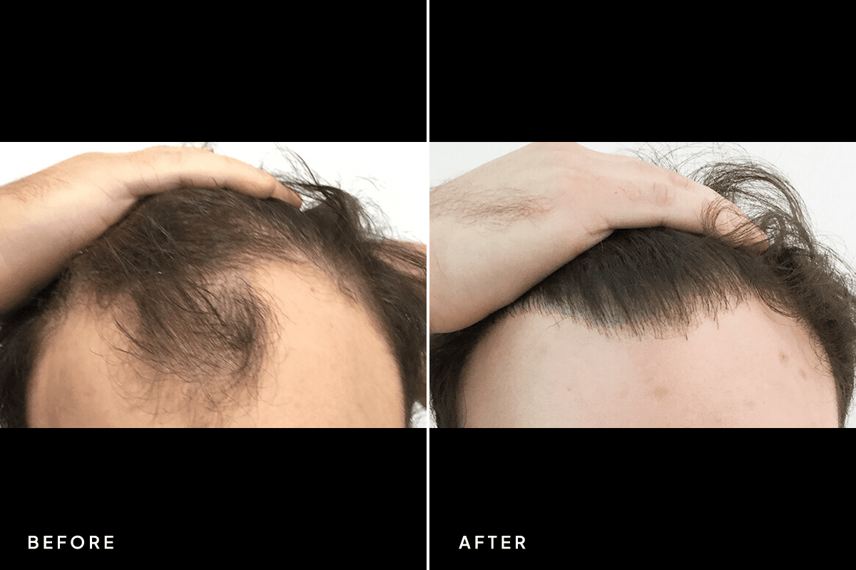 New Horizons Hair Gallery | Hair Transplant | 6606-artas-hair-transplant | A Front