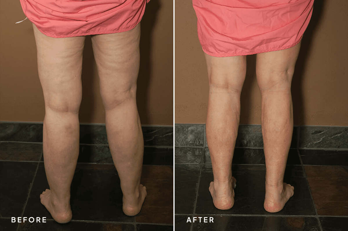 New Horizons Body Gallery | Liposuction | 6940-liposuction | A Front