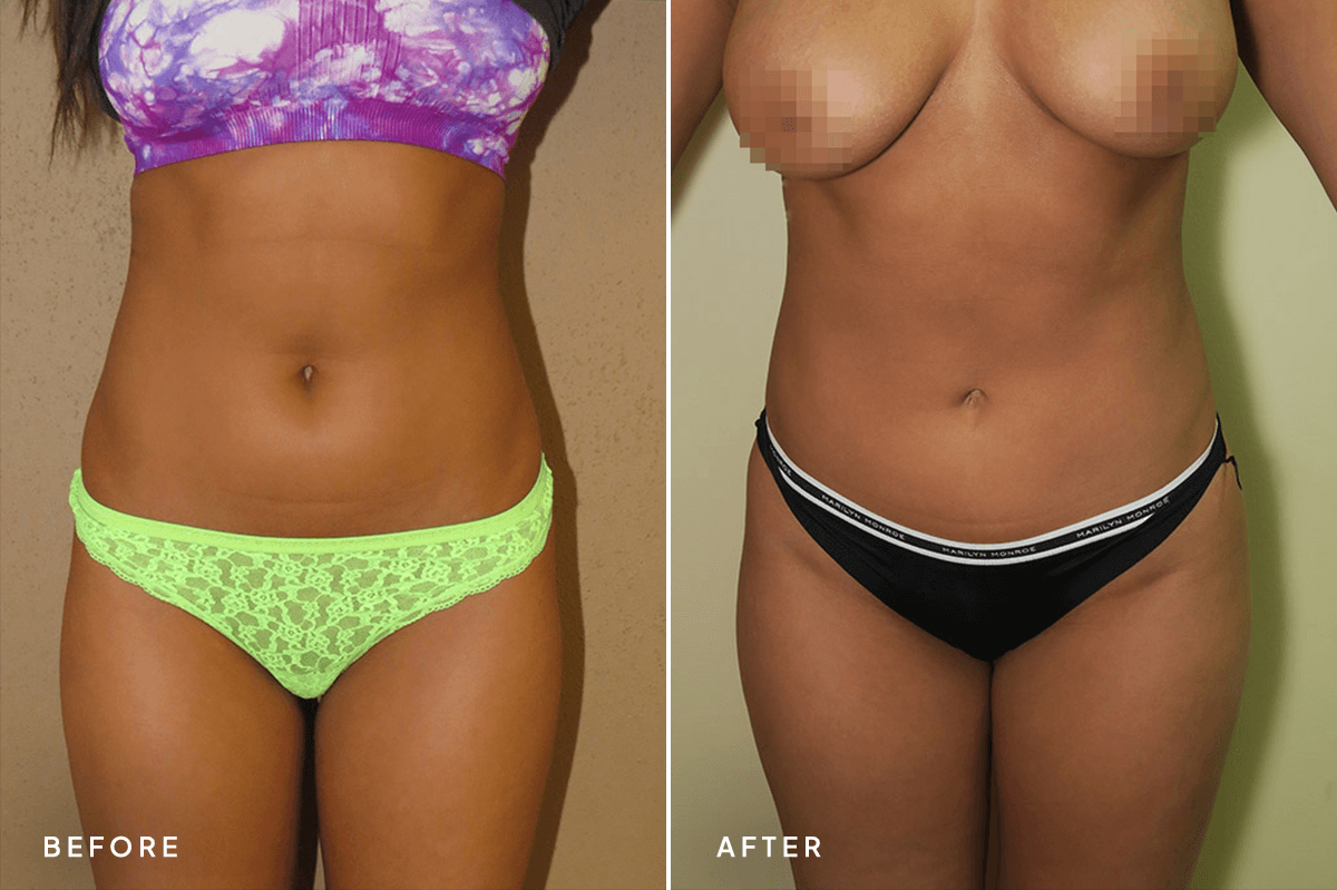 New Horizons Body Gallery | Liposuction | 34-abdominoplasty | A Front