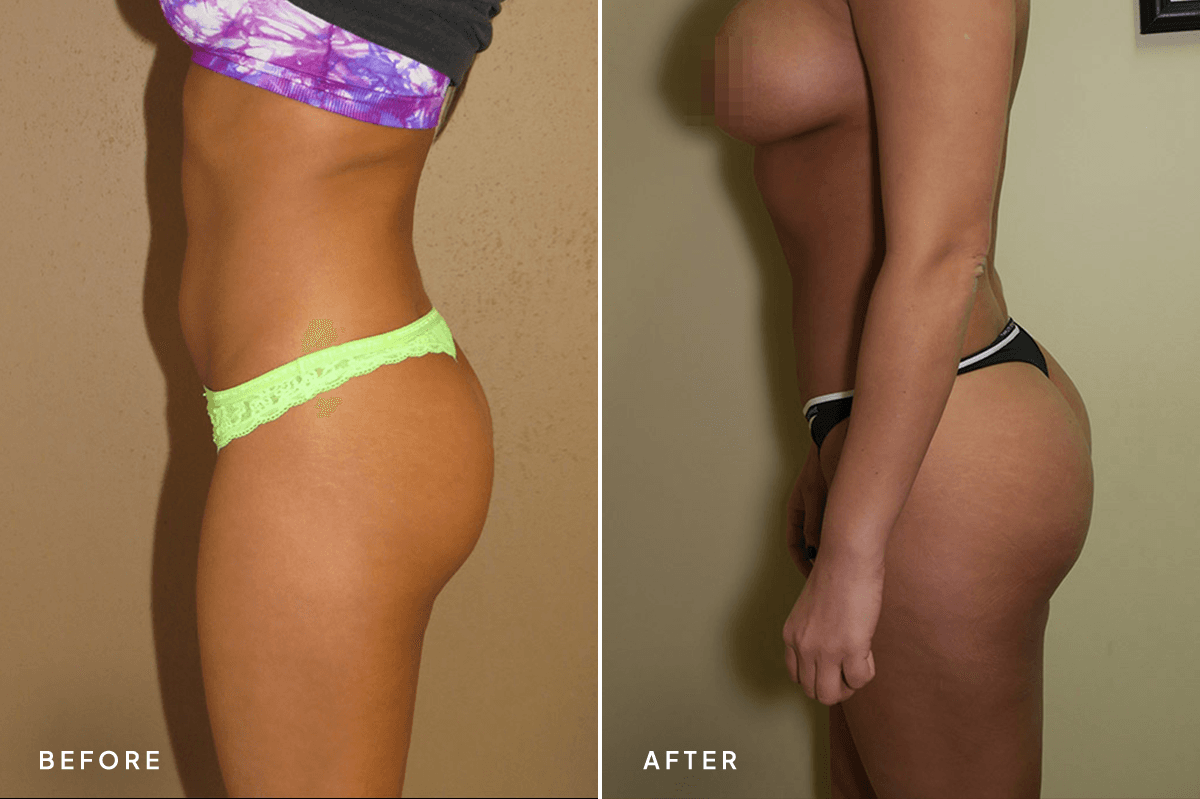 New Horizons Body Gallery | Liposuction | 34-abdominoplasty | B Side