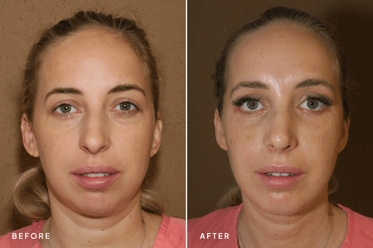 New Horizons Face Gallery | Chin Augmentation | 7135-rhinoplasty | A Front