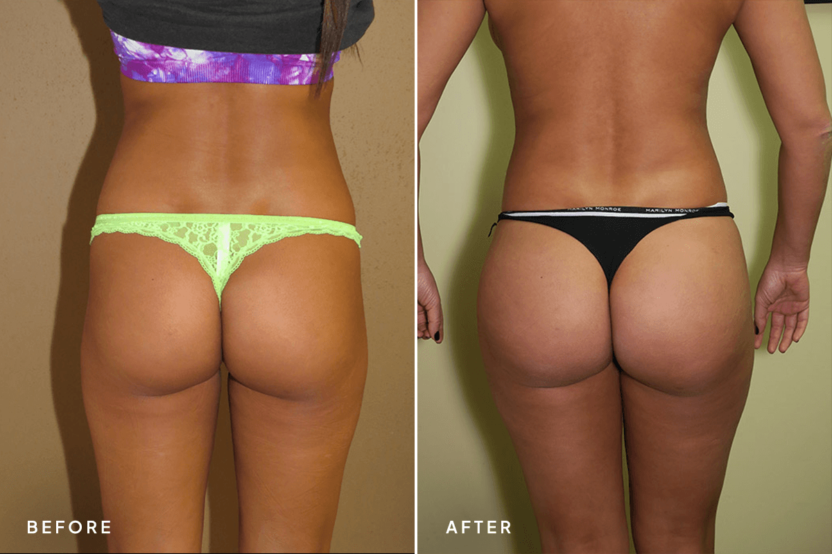 New Horizons Body Gallery | Liposuction | 34-abdominoplasty | C Angle