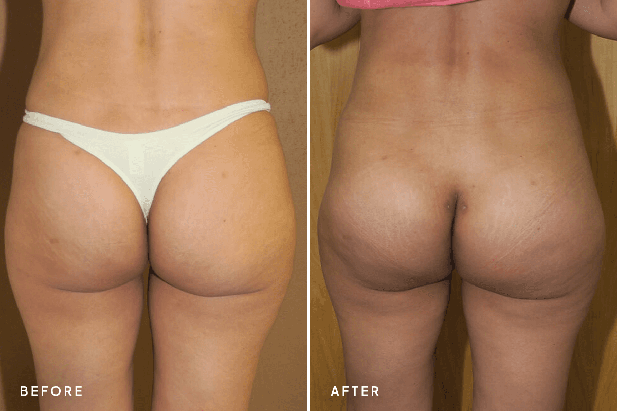 New Horizons Body Gallery | Buttock Augmentation Implants | 7129-buttock-augmentation | A Front