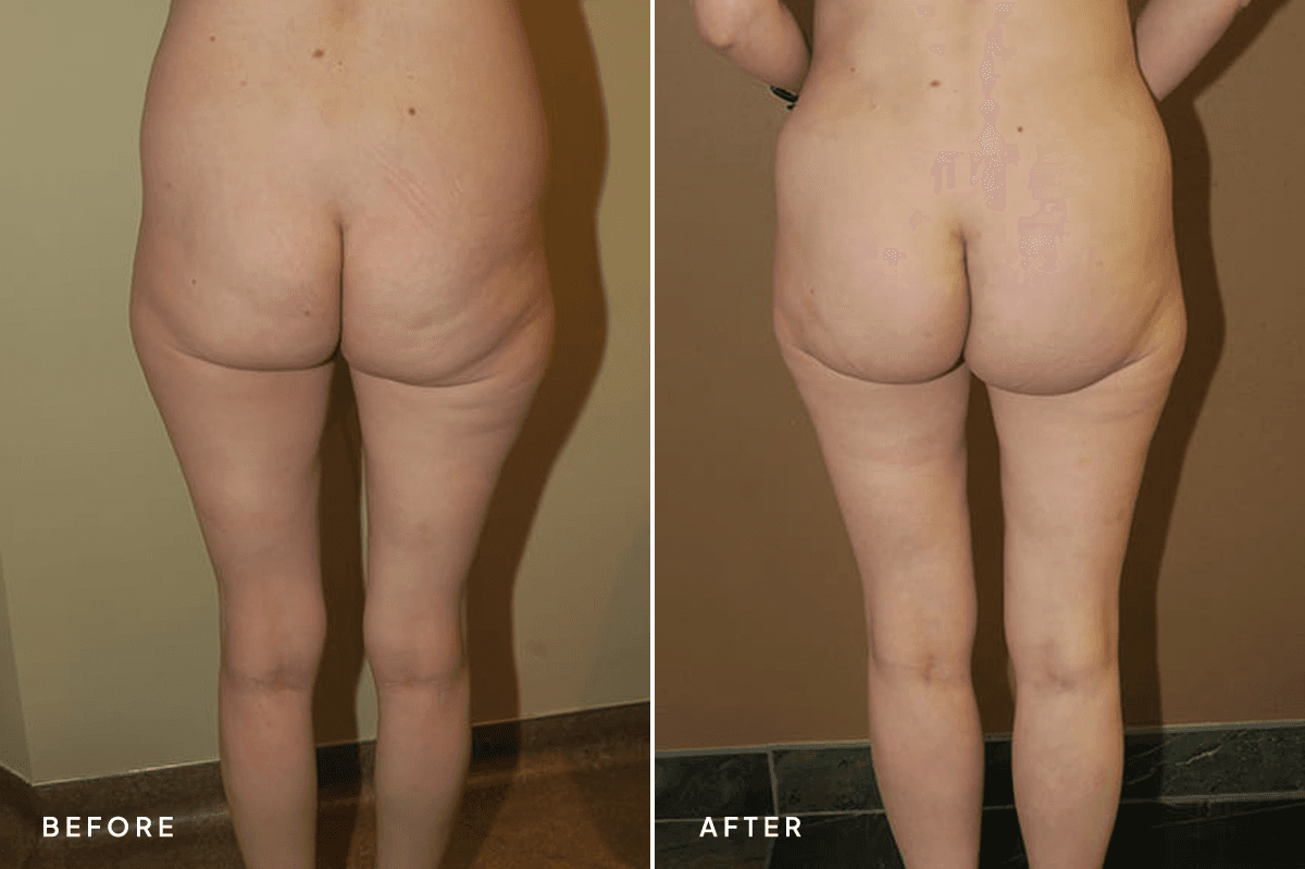 New Horizons Body Gallery | Buttock Augmentation Implants | 7189-buttock-augmentation | A Front