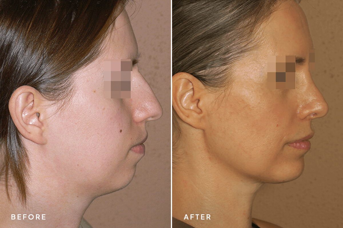 New Horizons Face Gallery | Chin Augmentation | 6852-chin-augmentation | A Side