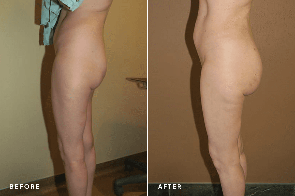 New Horizons Body Gallery | Buttock Augmentation Implants | 7189-buttock-augmentation | B Side