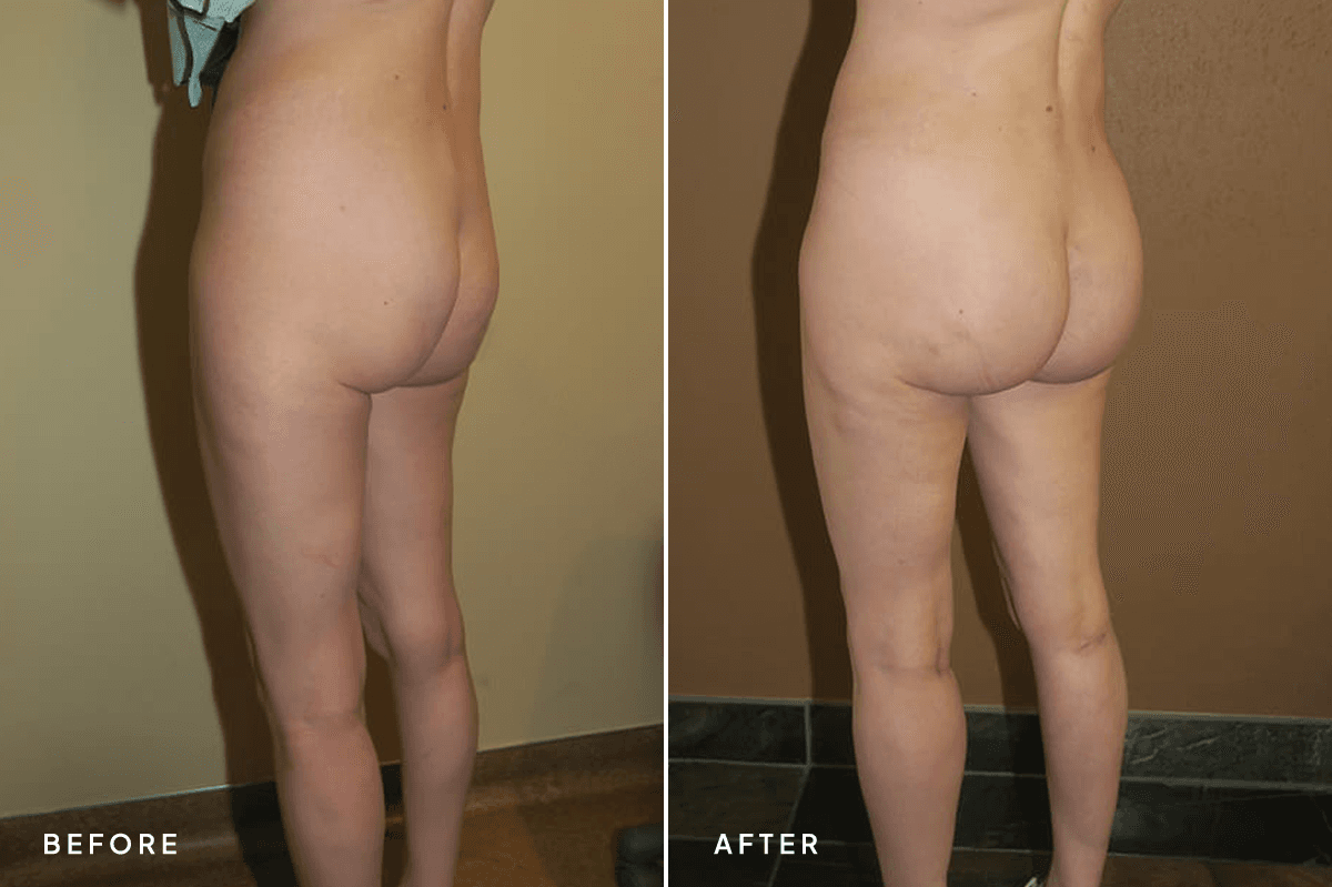 New Horizons Body Gallery | Buttock Augmentation Implants | 7189-buttock-augmentation | C Angle