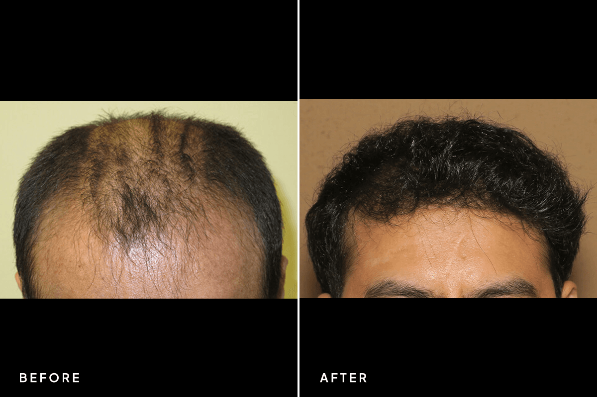 New Horizons Hair Gallery | Hair Transplant | 6293-artas-hair-transplant | A Front