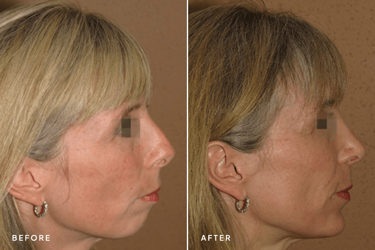 New Horizons Face Gallery | Chin Augmentation | 726 rhinoplasty-and-chin-implant | A Side