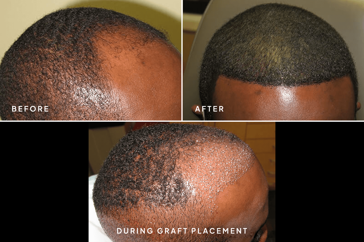 New Horizons Hair Gallery | Hair Transplant | 6652-artas-hair-restoration | A Angle