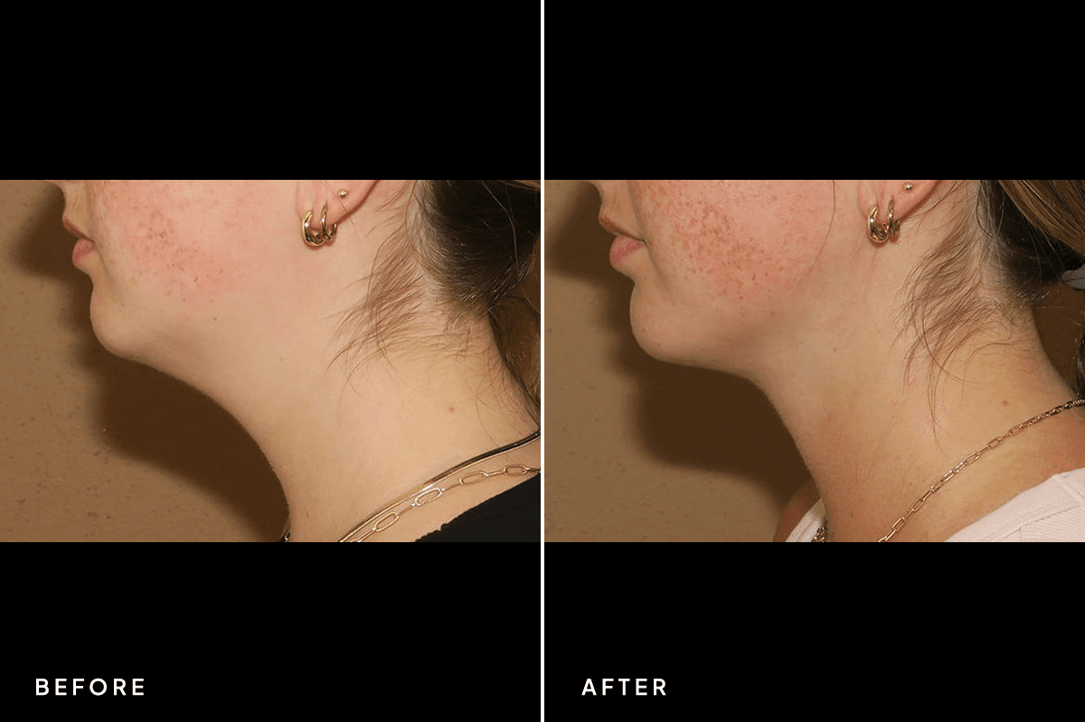 New Horizons Body Gallery | Liposuction | 7213-neck-liposuction | A Side