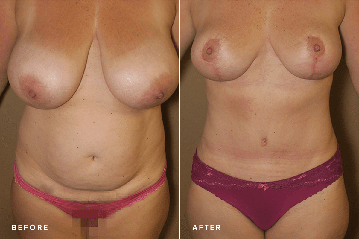 New Horizons Body Gallery | Mommy Makeover | 56-mommy-makeover | A Front