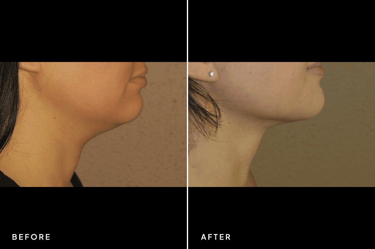 New Horizons Body Gallery | Liposuction | 7090-neck-liposuction | A Side