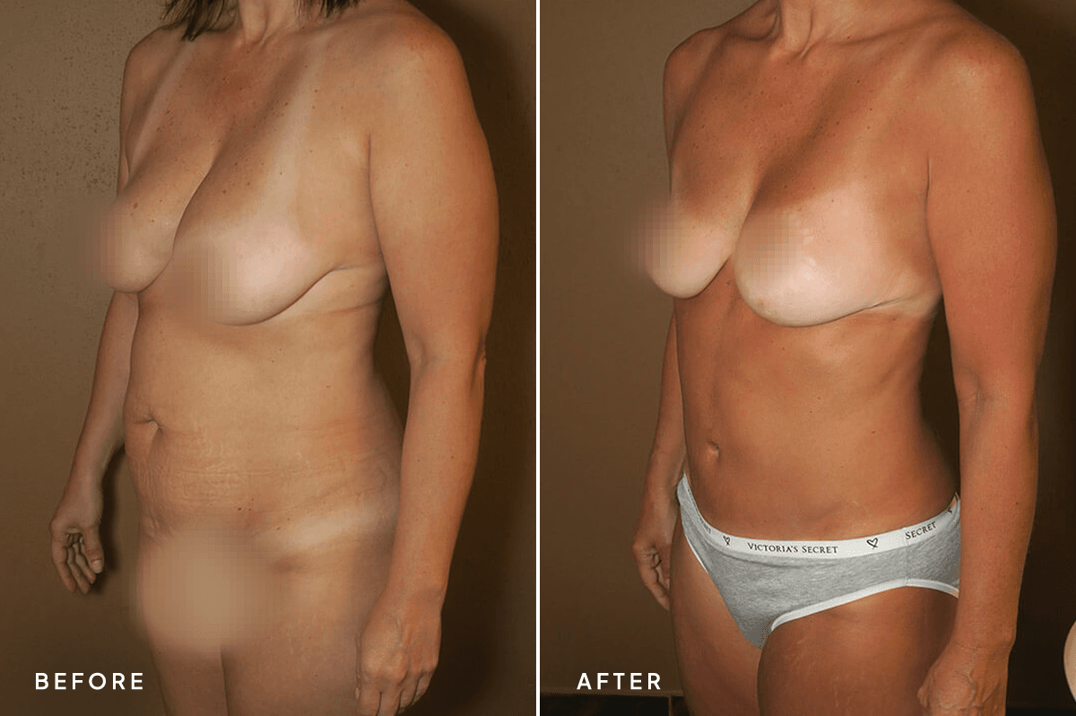 New Horizons Body Gallery | Mommy Makeover | 61-mommy-makeover | C Angle