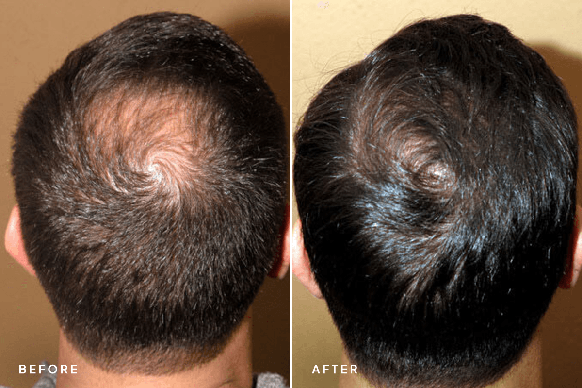 New Horizons Hair Gallery | Hair Transplant | 236-hair-transplant | A Back