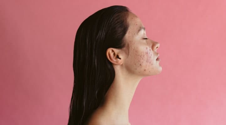 Acne Tips from a Dermatologist