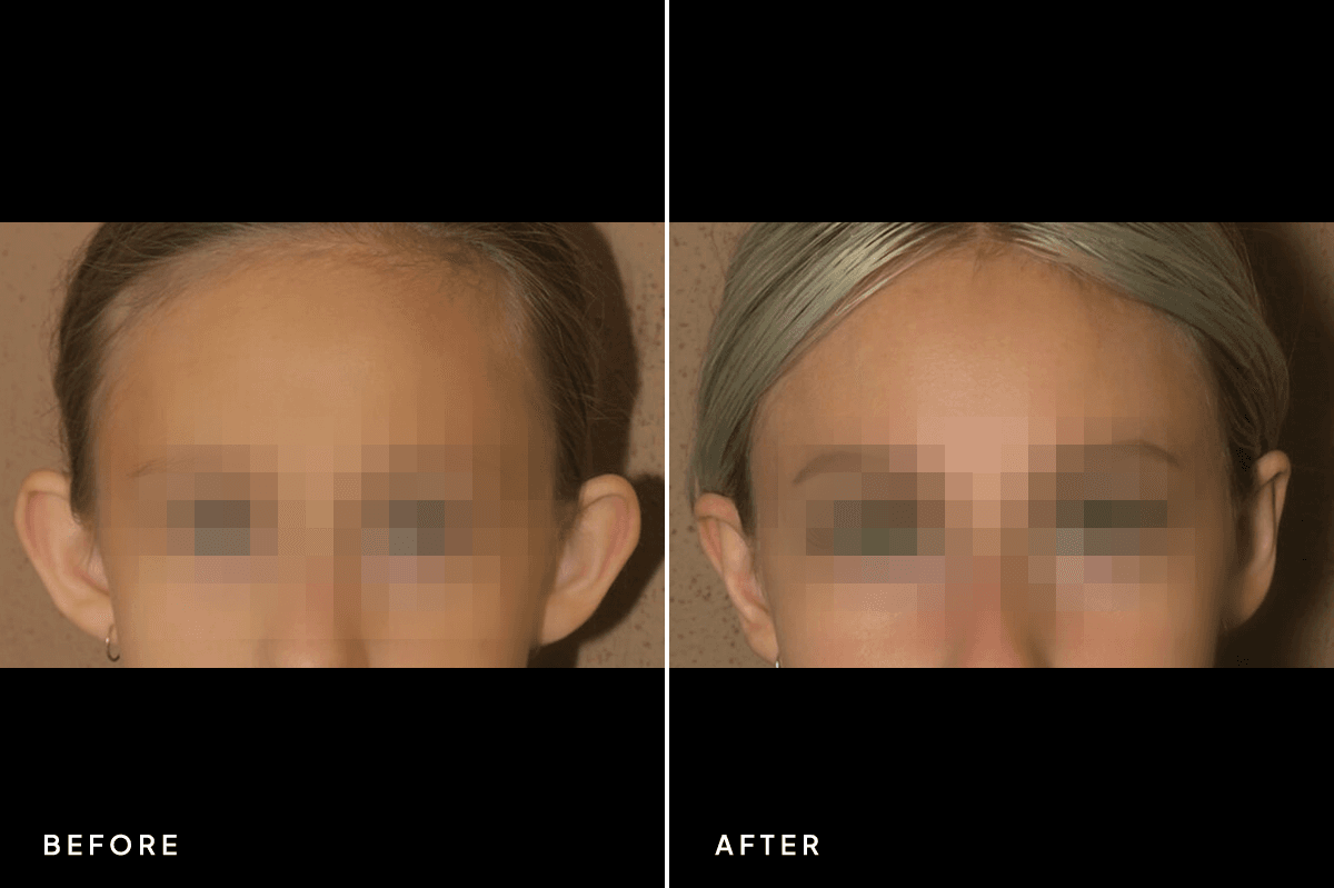 New Horizons Face Gallery | Otoplasty | 6630-otoplasty | A Front