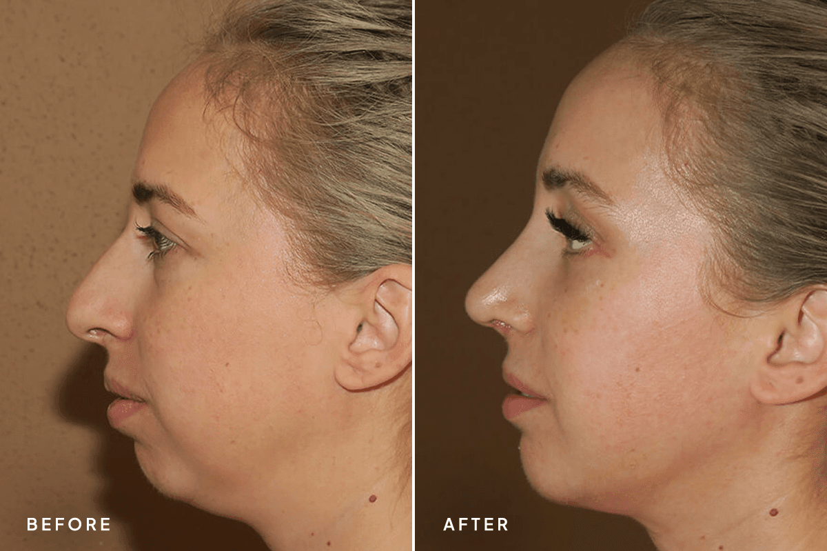 New Horizons Face Gallery | Chin Augmentation | 7135-rhinoplasty | C Angle