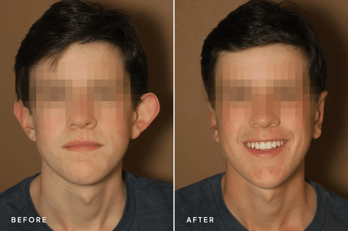 New Horizons Face Gallery | Otoplasty | 372-otoplasty | A Front