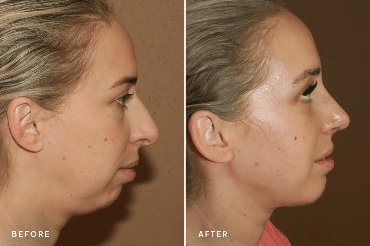 New Horizons Face Gallery | Chin Augmentation | 7135-rhinoplasty | B Side