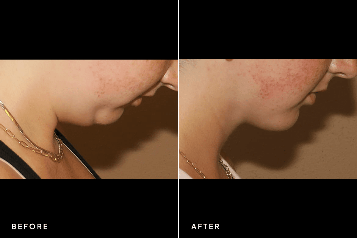 New Horizons Body Gallery | Liposuction | 7213-neck-liposuction | B Side