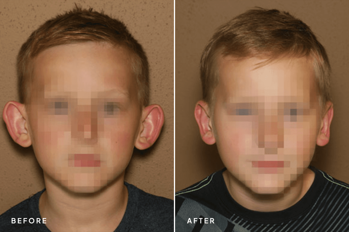 New Horizons Face Gallery | Otoplasty | 324-otoplasty | A Front