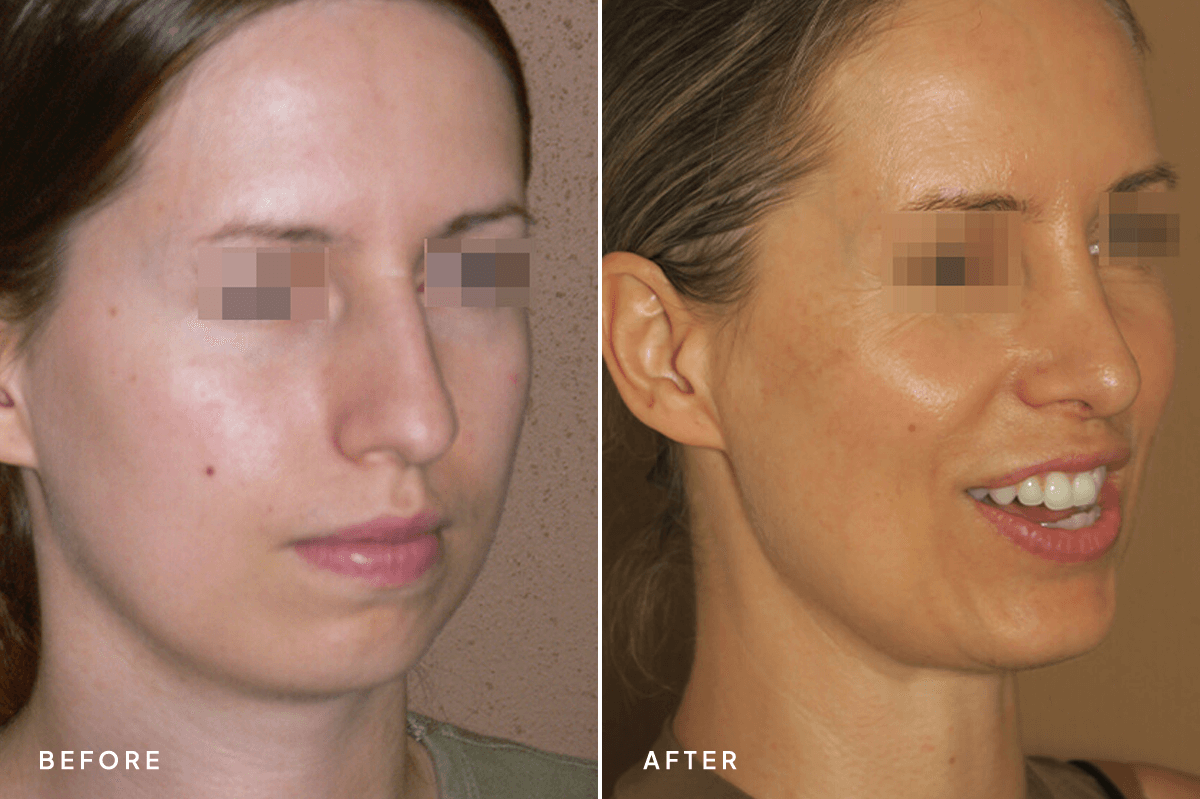New Horizons Face Gallery | Chin Augmentation | 6852-chin-augmentation | B Angle