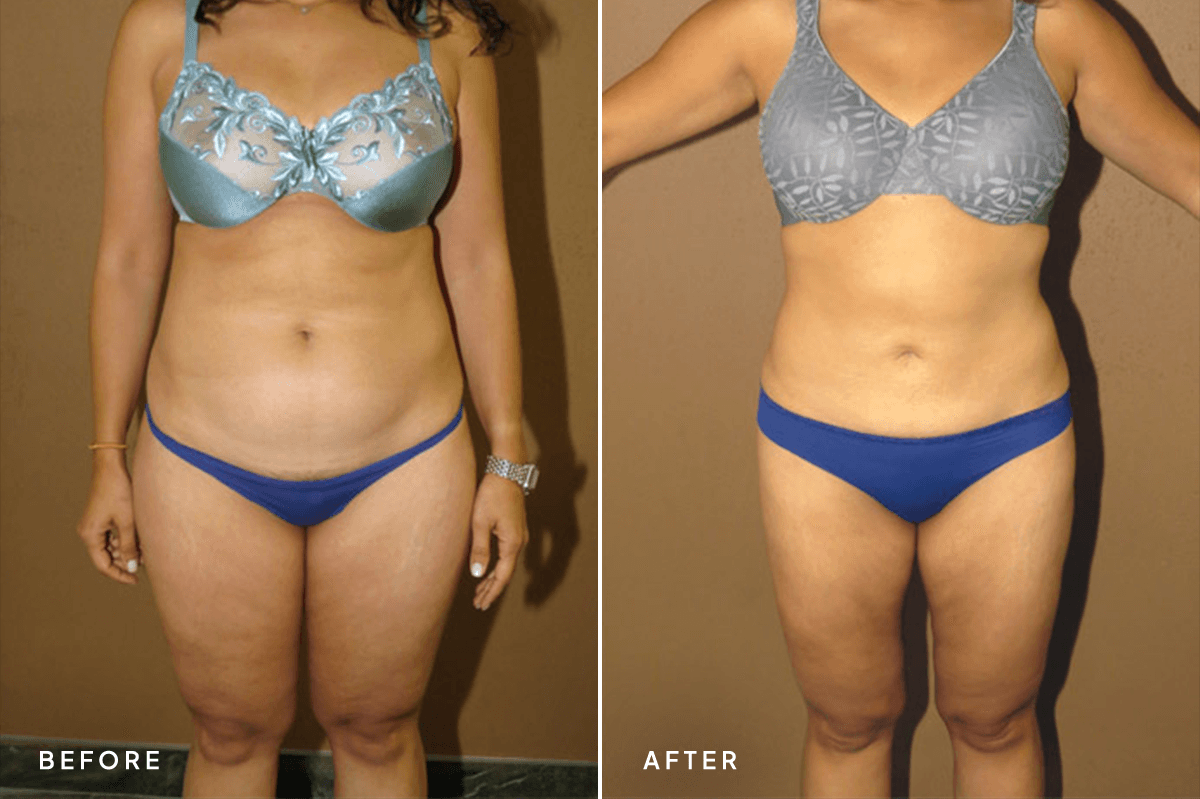 New Horizons Body Gallery | Liposuction | 011-liposuction | A Front