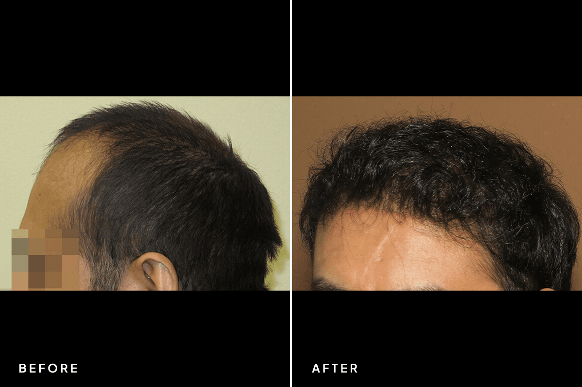 New Horizons Hair Gallery | Hair Transplant | 6293-artas-hair-transplant | B Side