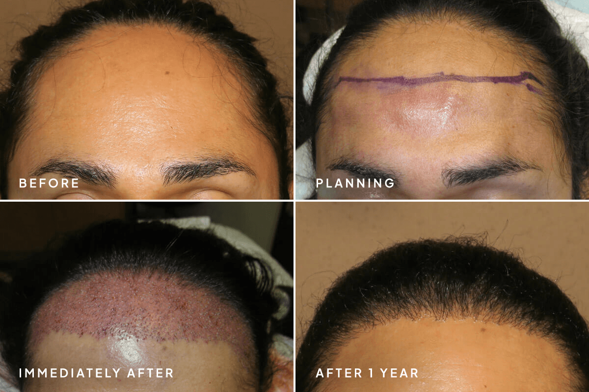 New Horizons Hair Gallery | Hair Transplant | 812-artas-robotic-hair-transplant | A Front