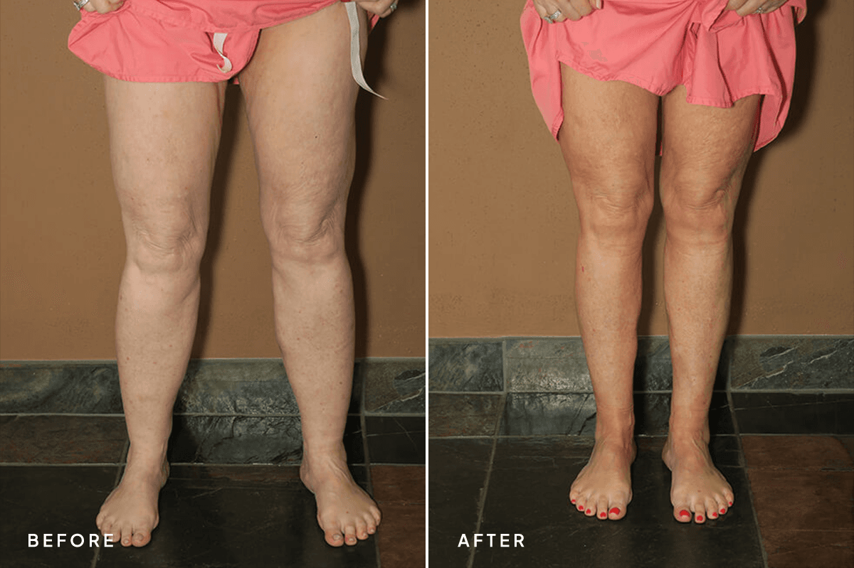 New Horizons Body Gallery | Liposuction | 6940-liposuction | C Angle