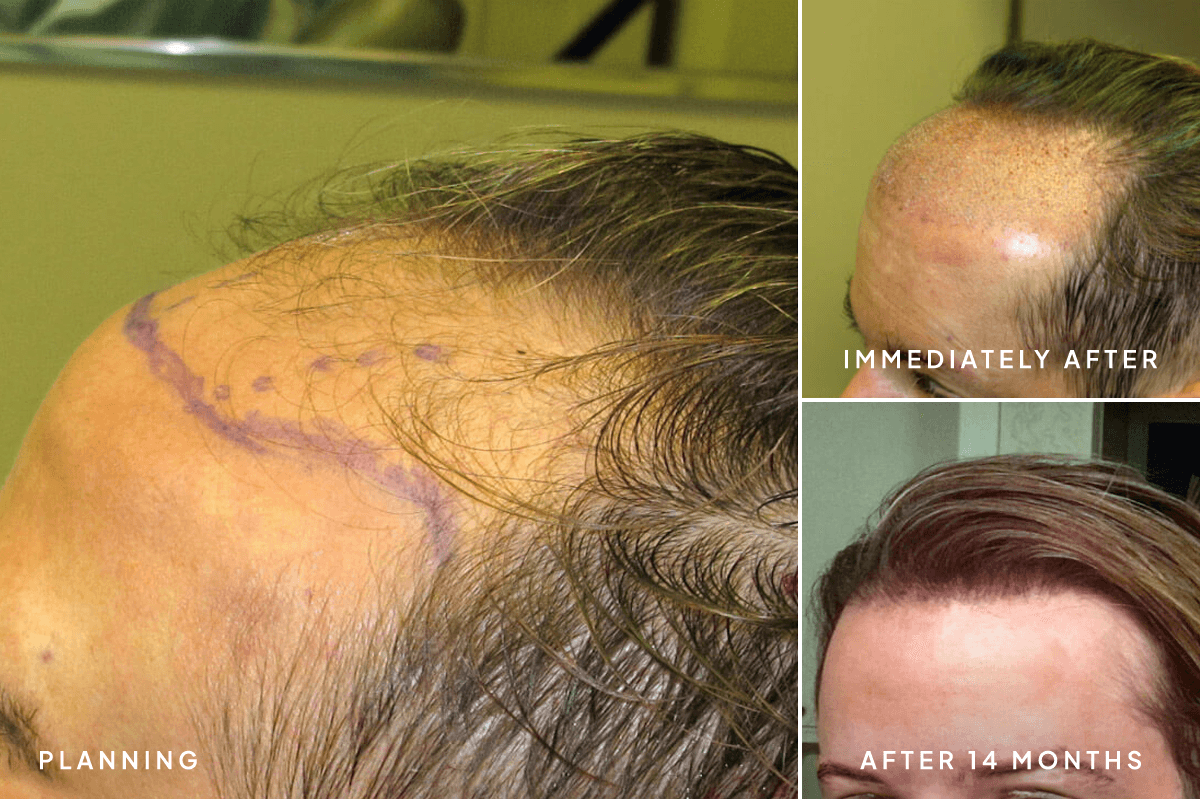 New Horizons Hair Gallery | Hair Transplant | 0001-artas-robotic-hair-transplant | B Side
