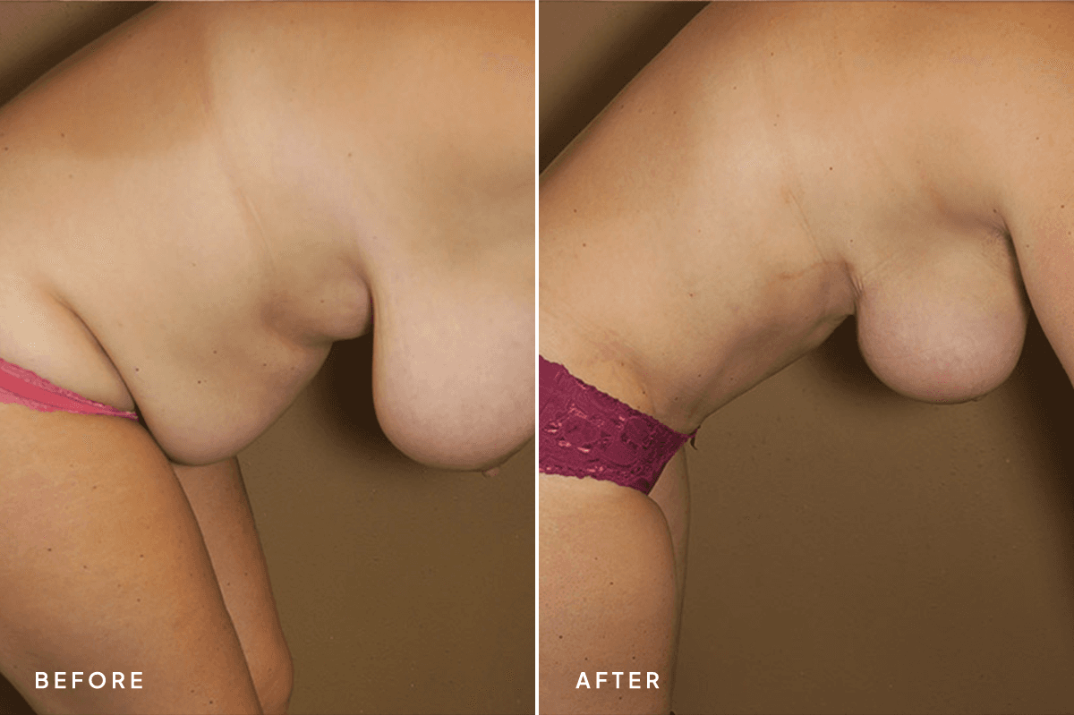 New Horizons Body Gallery | Mommy Makeover | 56-mommy-makeover | D Angle