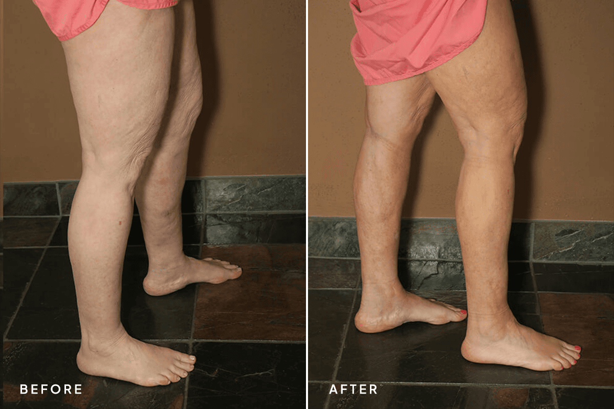 New Horizons Body Gallery | Liposuction | 6940-liposuction | B Side
