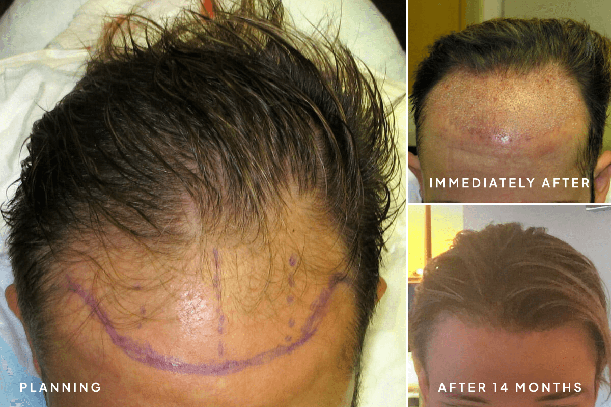 New Horizons Hair Gallery | Hair Transplant | 0001-artas-robotic-hair-transplant | A Front