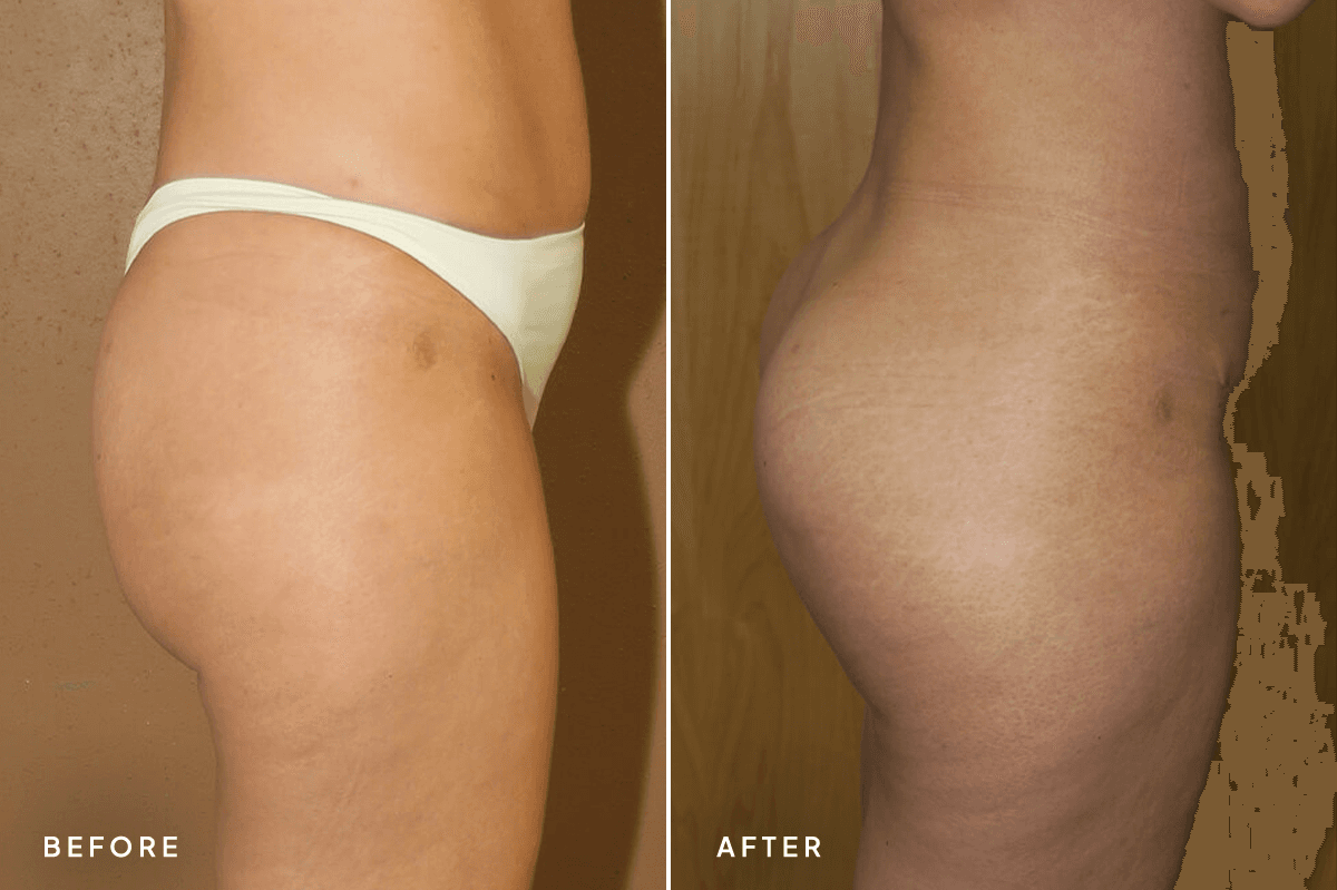 New Horizons Body Gallery | Buttock Augmentation Implants | 7129-buttock-augmentation | C Side