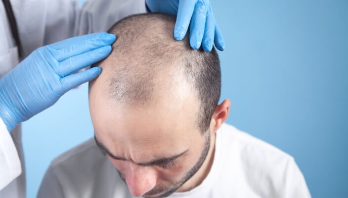 dermatologist inspecting man with hair loss